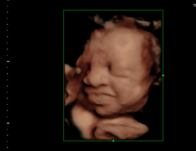 3D ultrasound image at 29 weeks
